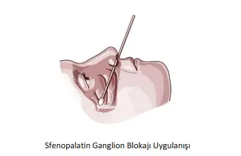 Baş Ağrısı Tedavi Süreci